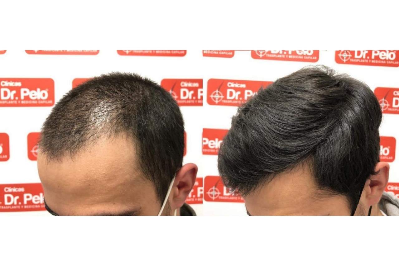 Clínicas Dr. Pelo: Trasplante capilar en Madrid