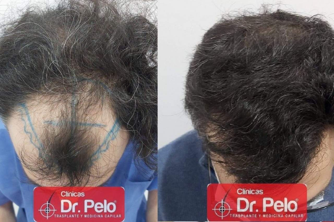 Clínica Dr. Pelo: injerto capilar en Sevilla
