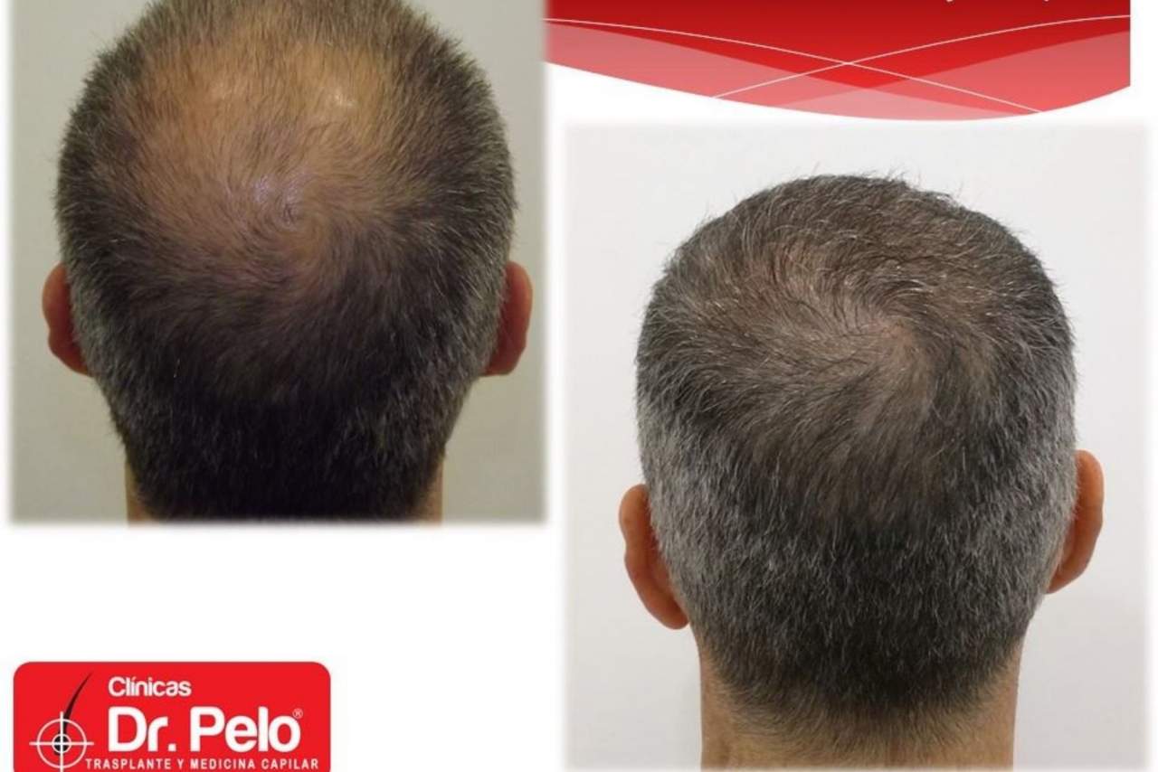 ¿El trasplante capilar es la nueva tendencia en medicina estética?: Dr. Pelo
