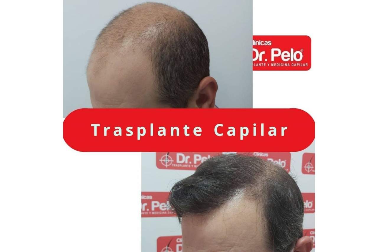 El transplante capilar gana popularidad en los últimos años en España tras mejorar los precios y las técnicas aplicadas