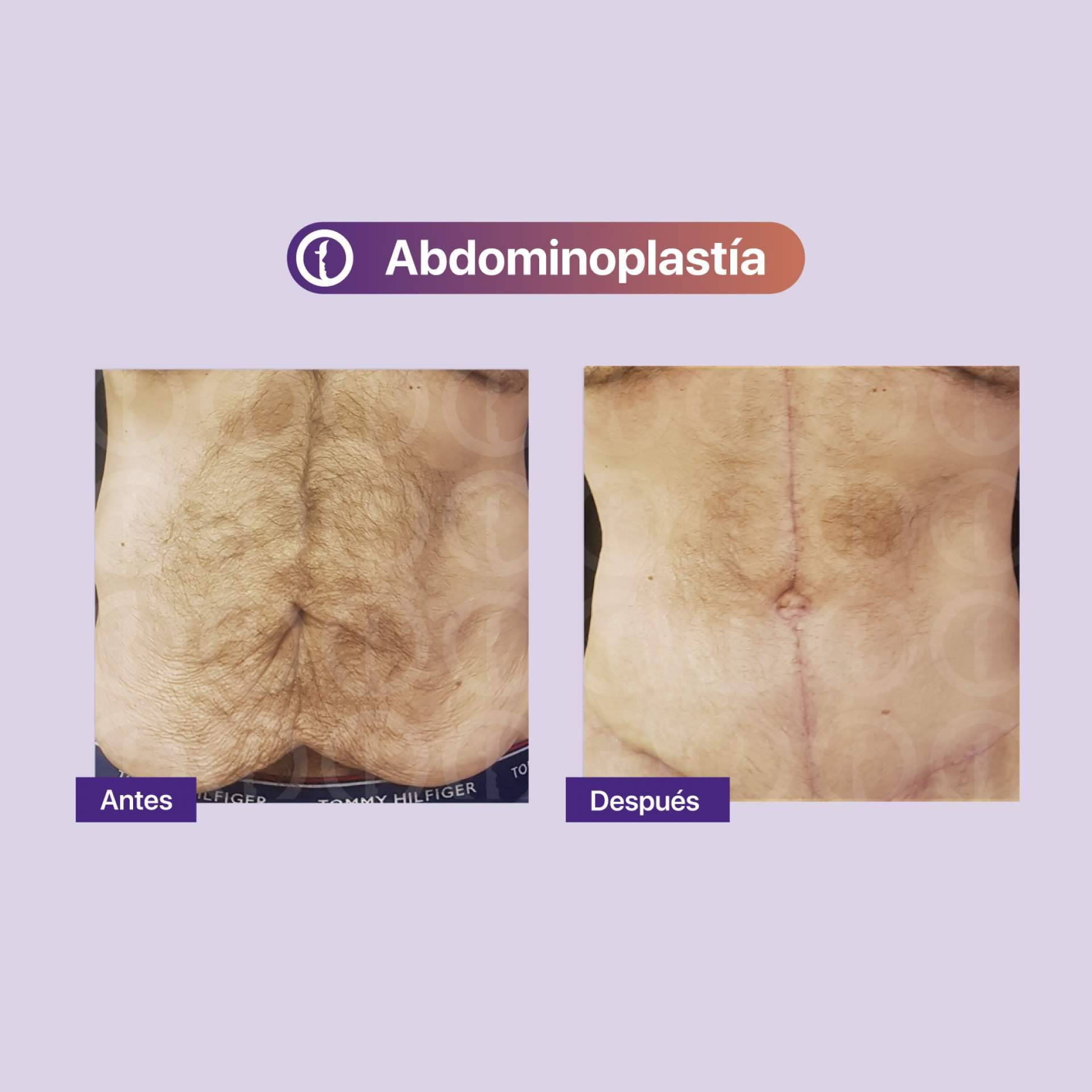 Clínica Tarrazo: la técnica de la abdominoplastia