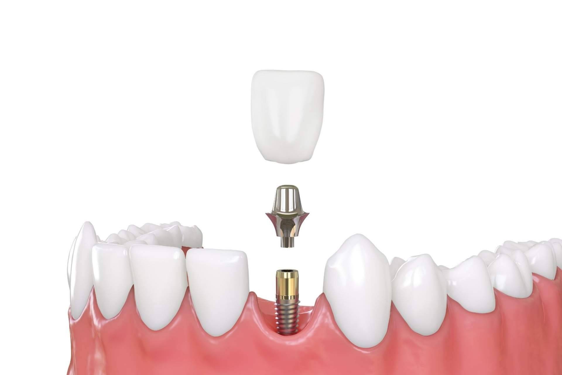 ¿Qué son los implantes de carga inmediata de Implant Clinics?