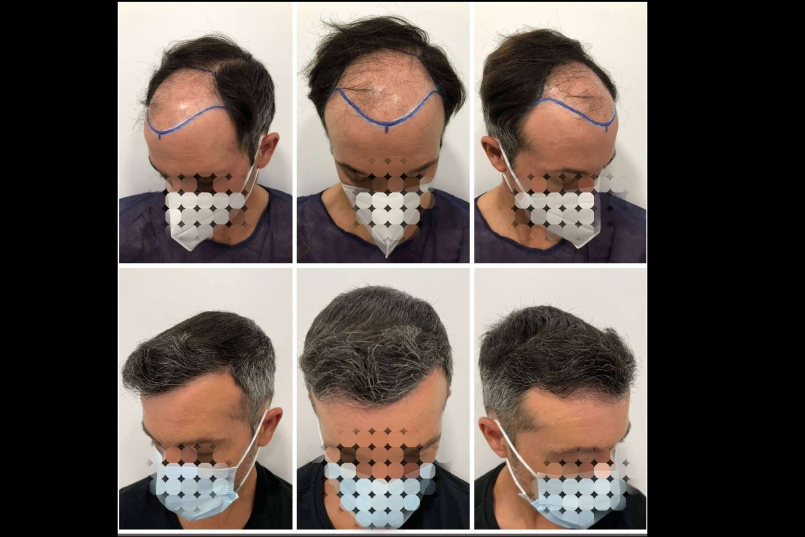 Las técnicas más recomendadas por el especializado Dr Bruno Jacobovski son el injerto o trasplante capilar