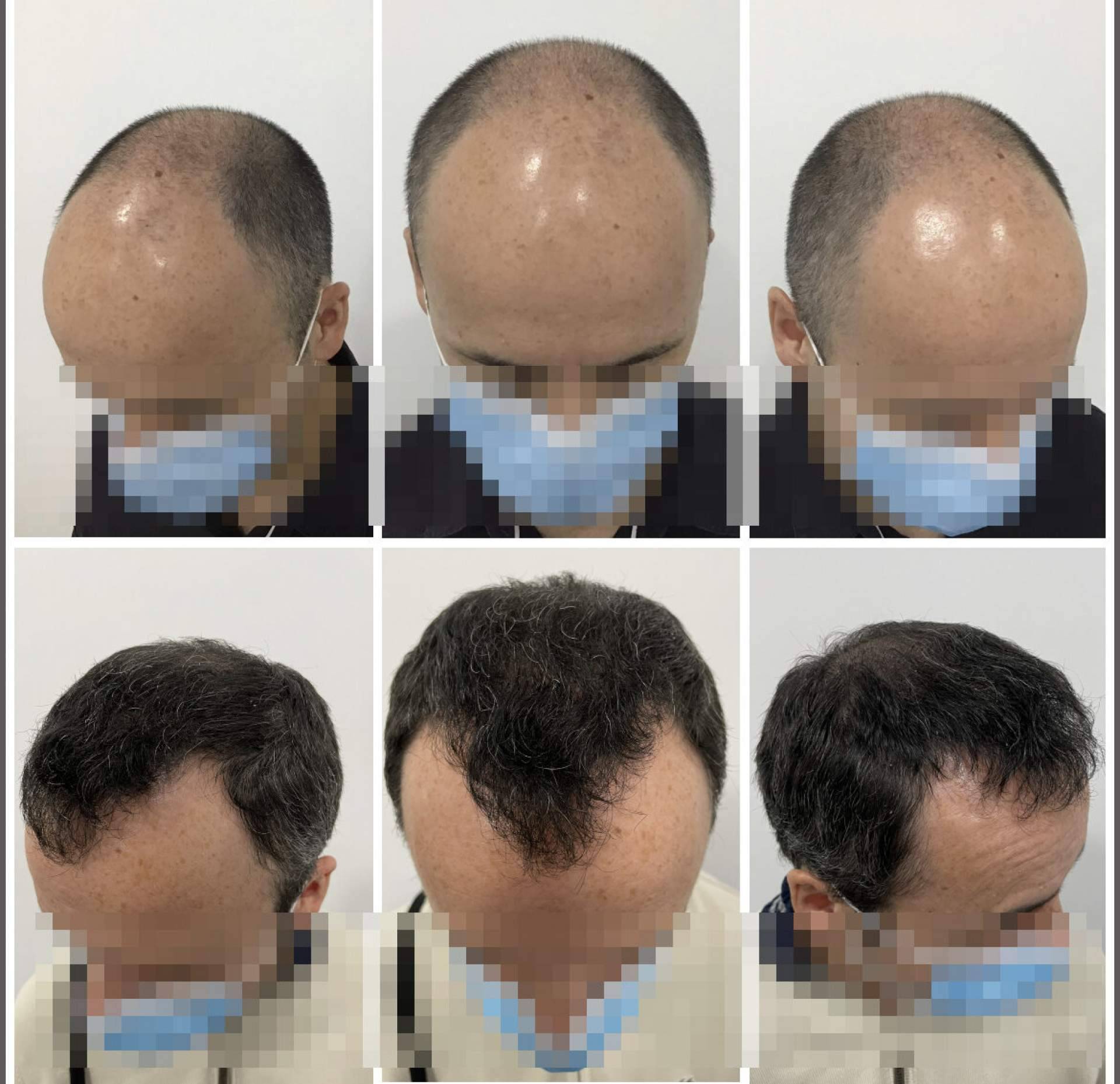 El injerto capilar en Barcelona más natural y denso ofrecido por el Dr. Bruno Jacobovski