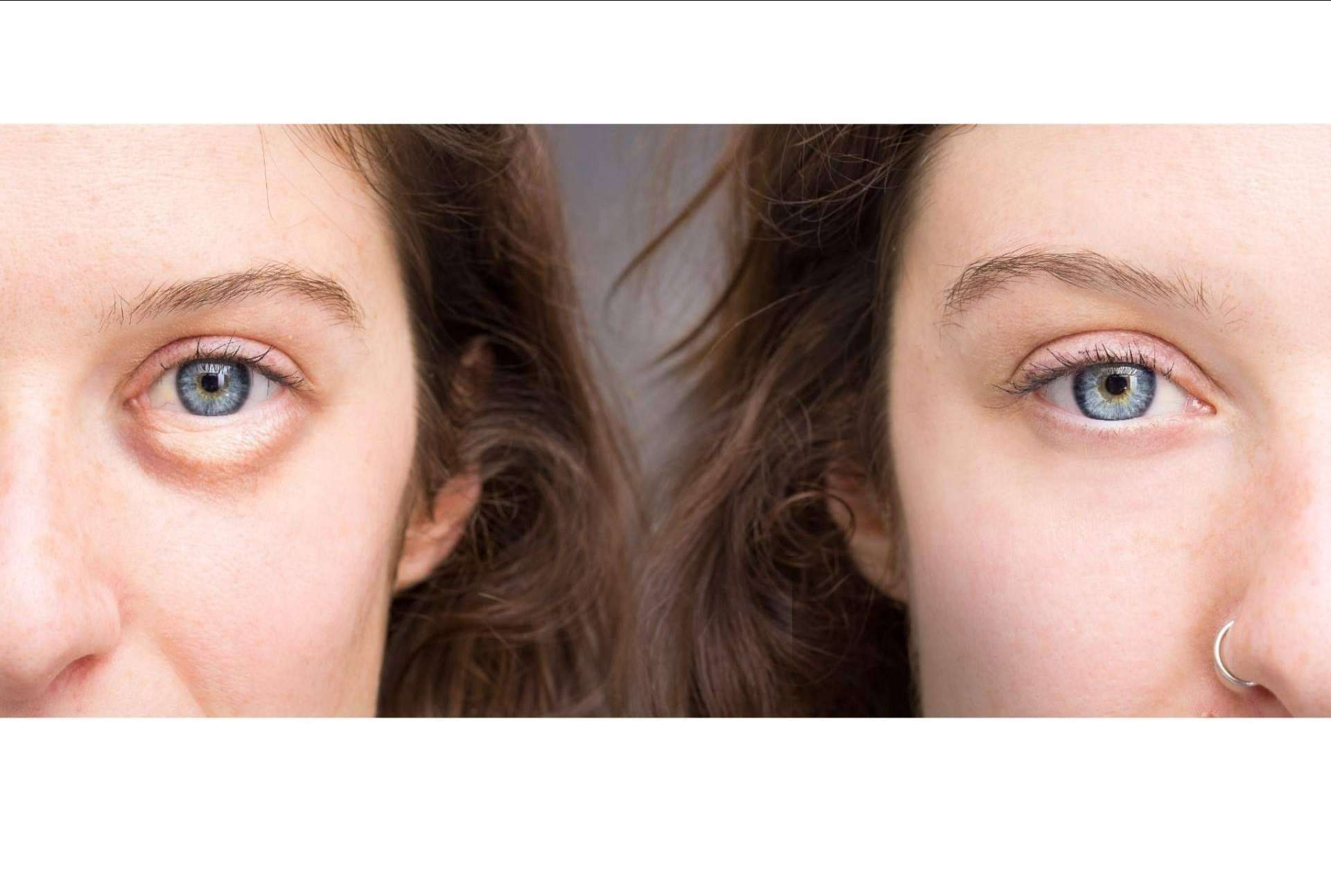 Unidad de medicina estética FEMME: ácido hialurónico para combatir las ojeras en Santiago de Compostela con la Dra. Alfonsina Uriburu