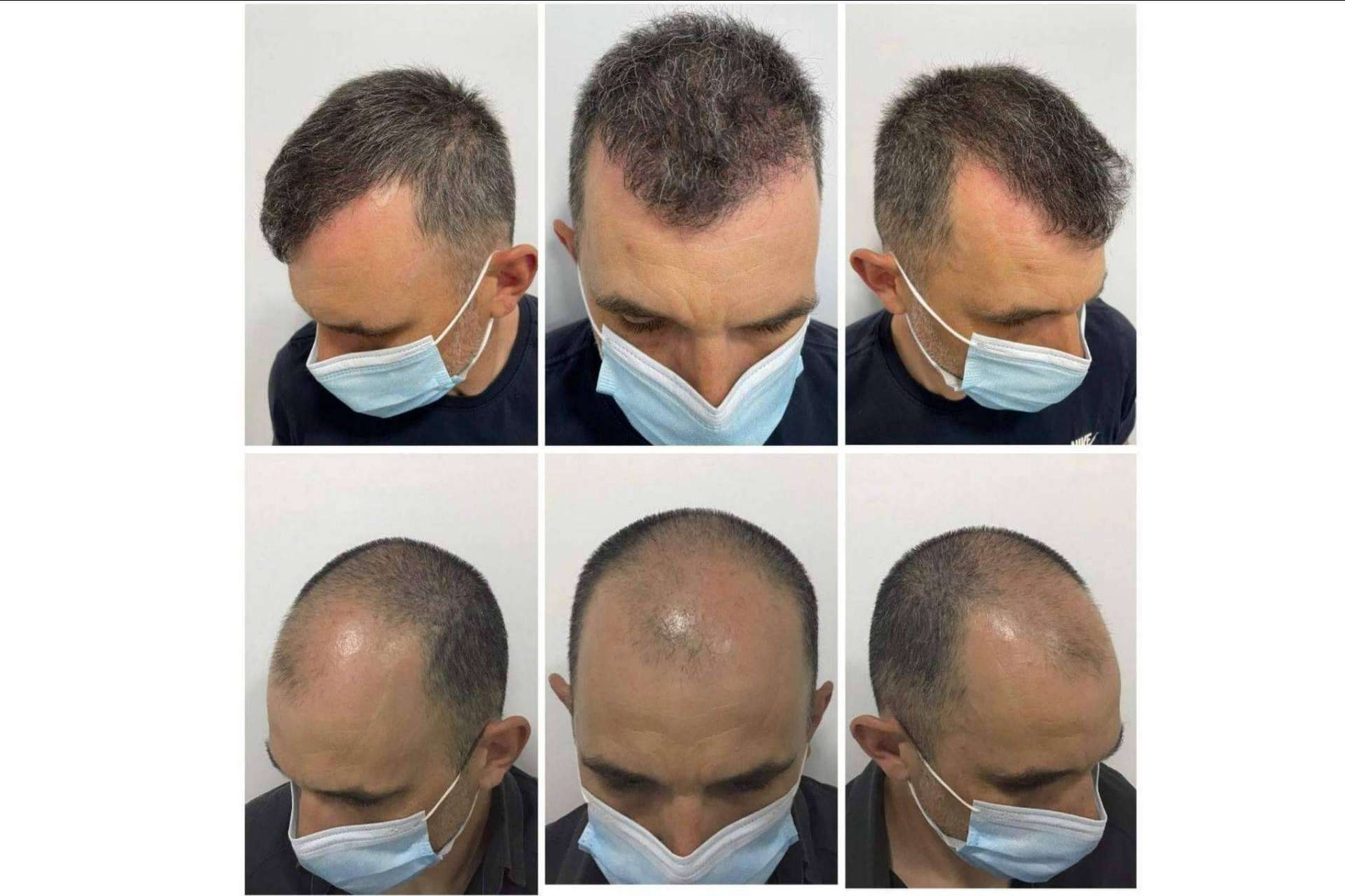Dr. Bruno Jacobovski: tratamiento de mesoterapia capilar