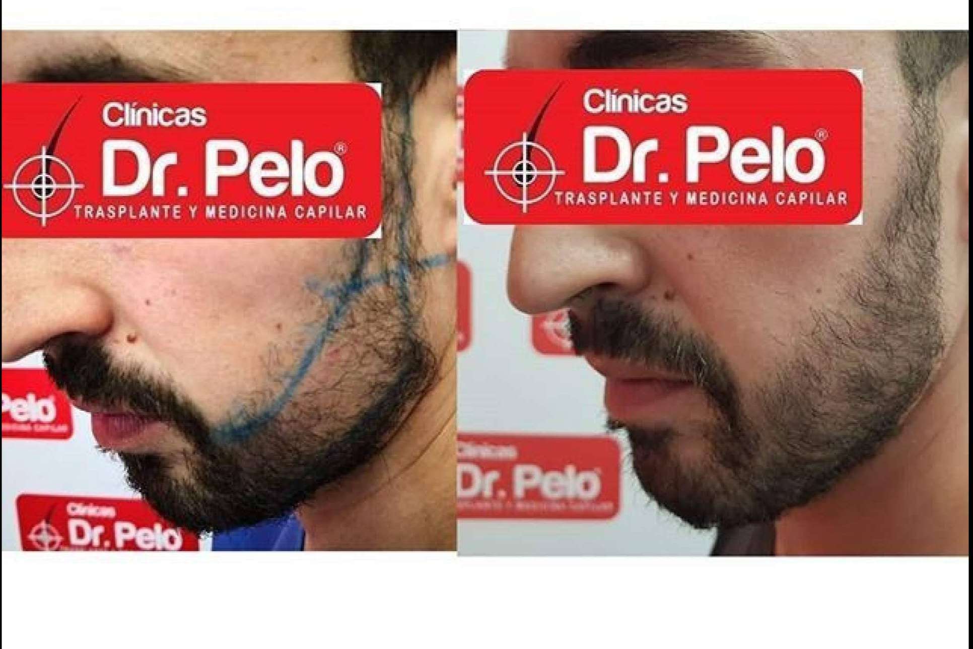 El trasplante de barba de Clínicas Dr. Pelo, uno de los tratamientos con mejores resultados