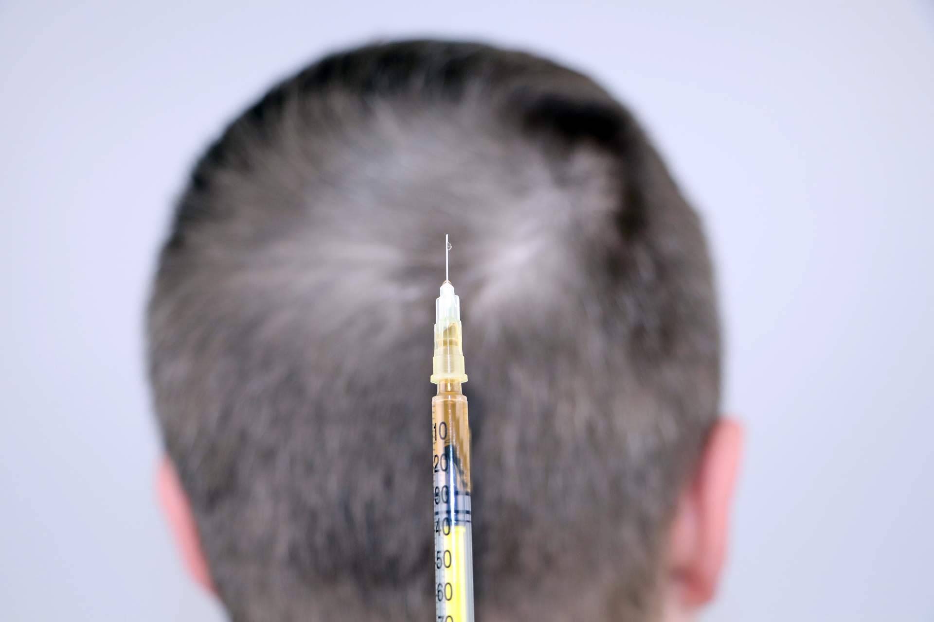El Dr. Bruno Jacobovski realiza mesoterapia capilar para el cuidado profundo del cuero cabelludo ante la caída del cabello