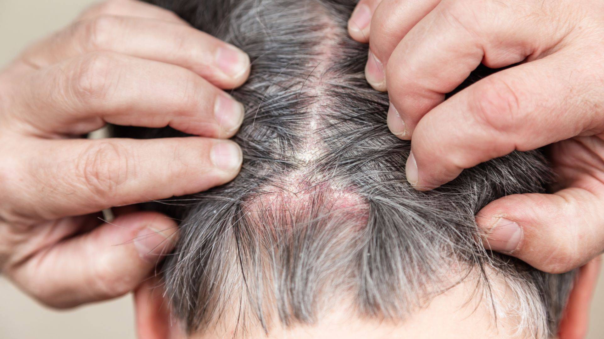 ¿La alopecia por tiña del cuero cabelludo puede ser contagiada por los perros?