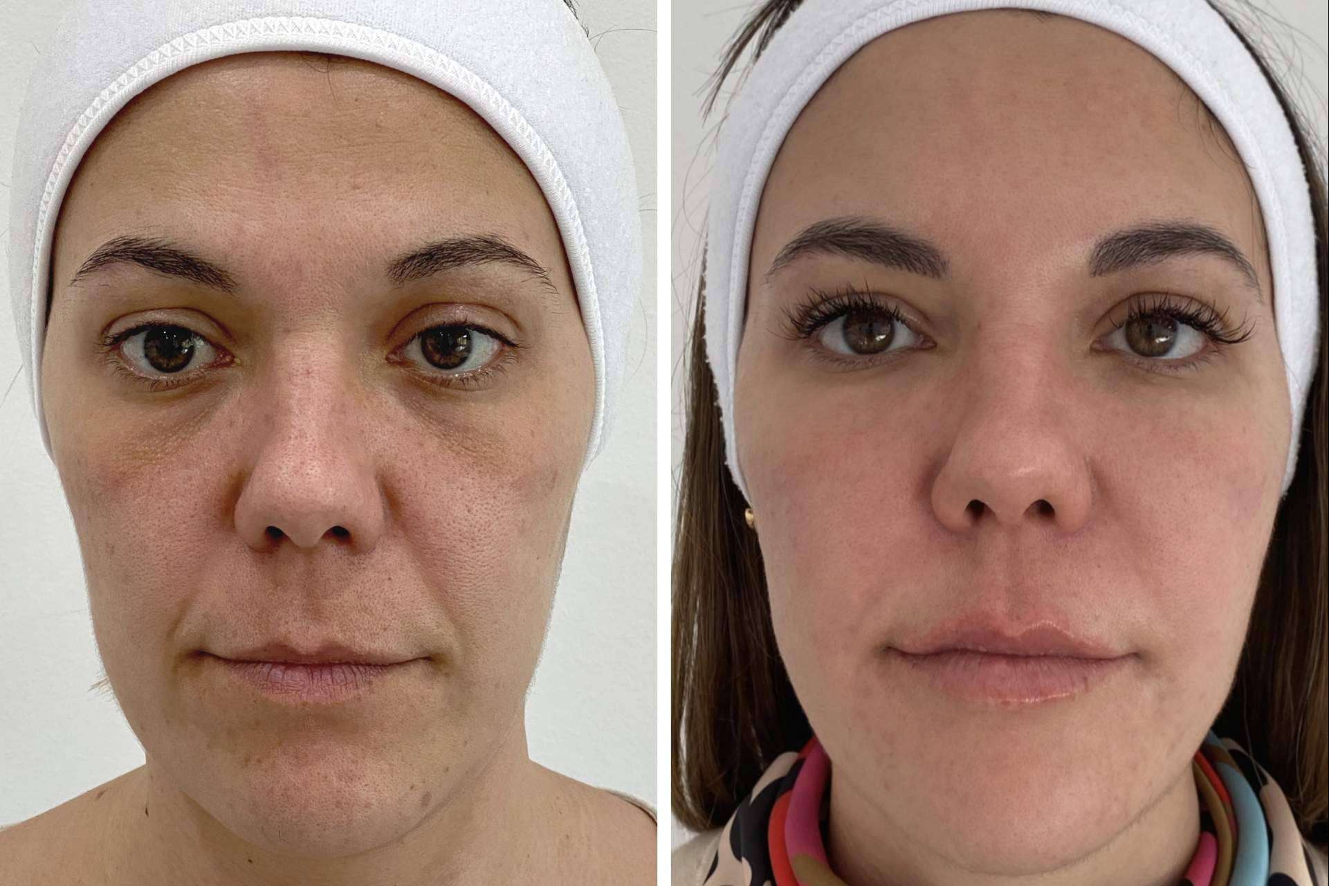 Mejorar la apariencia con los tratamientos faciales de Clínica VISO