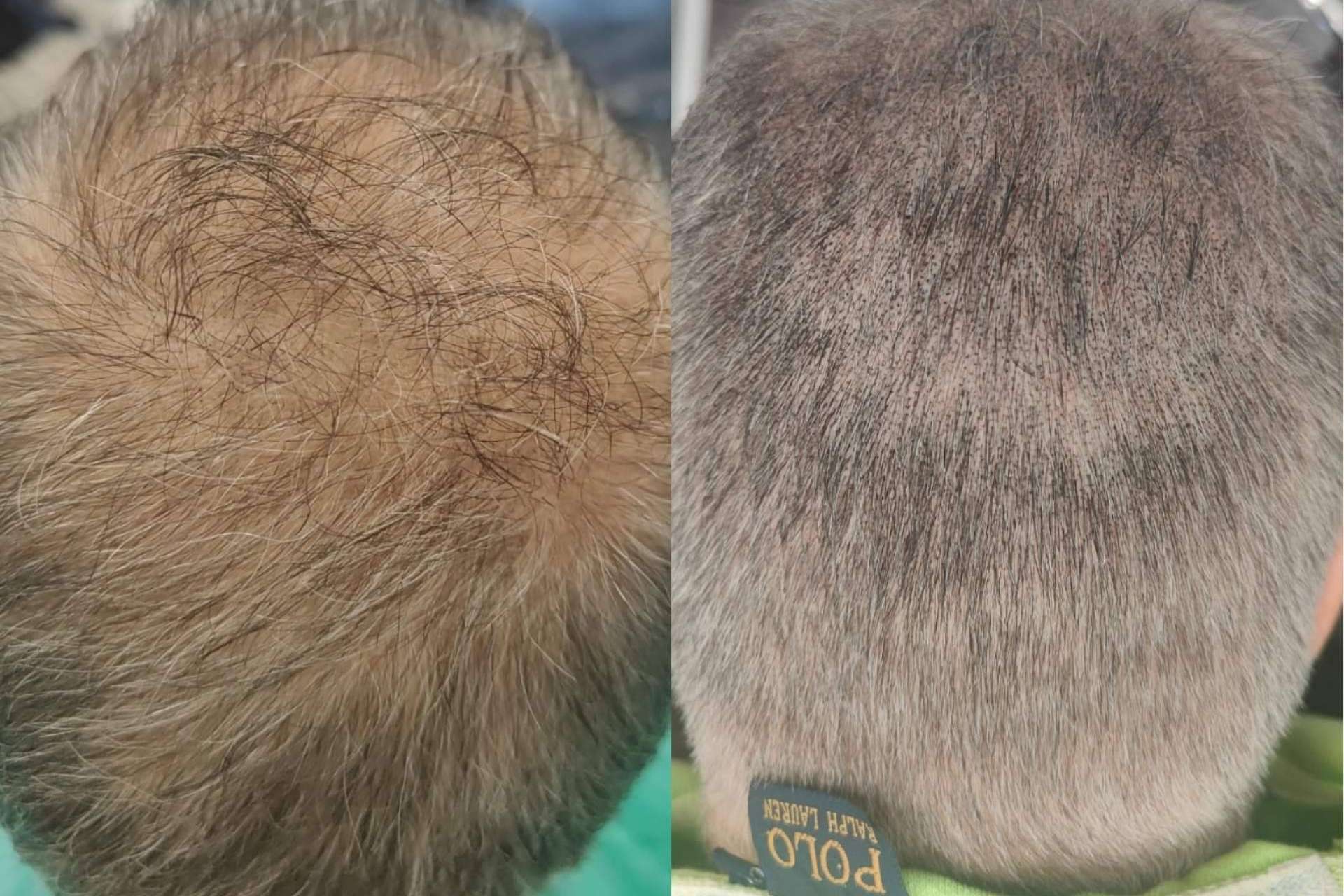 Los beneficios de la micropigmentación capilar, por Dermopigmentación Clínica