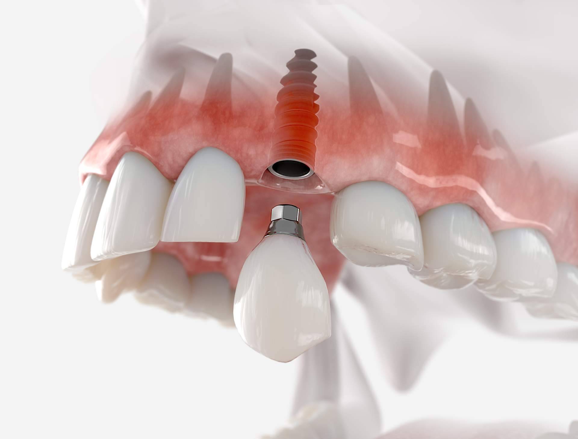 Los beneficios de los implantes dentales, por DeltaDent