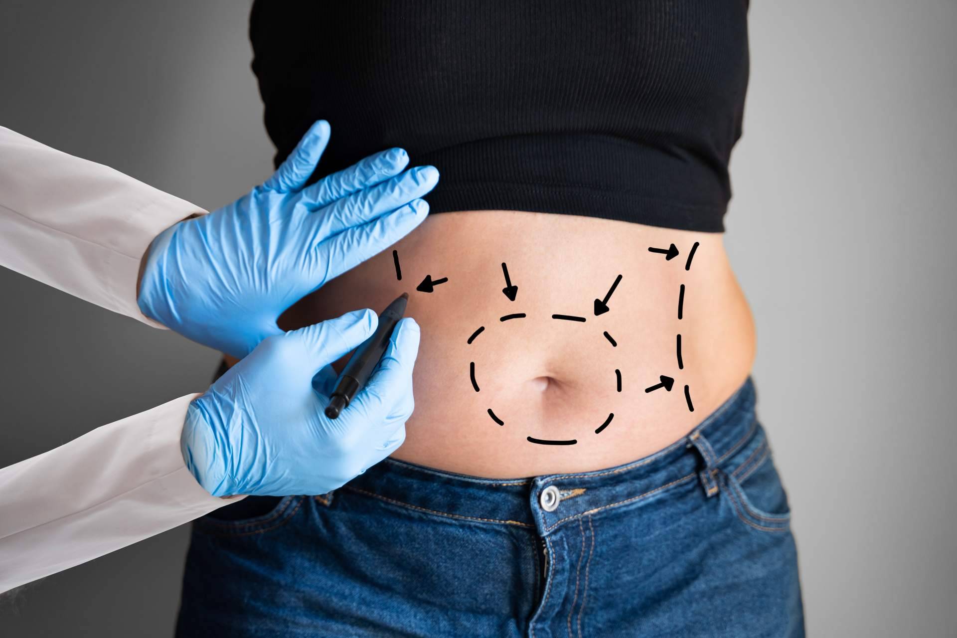 Abdominoplastia, una solución efectiva y segura para recuperar el abdomen plano